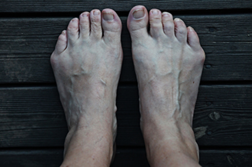 How Podiatrists Treat Painful Bunionettes