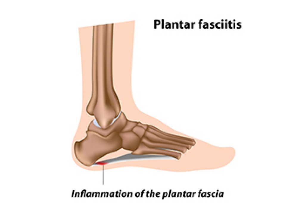 Plantar Fasciitis and the Role of the Windlass Mechanism