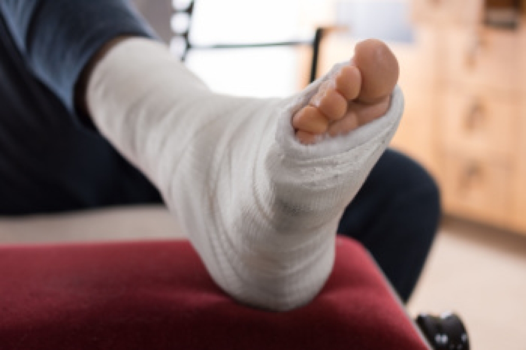 Common Foot Fractures