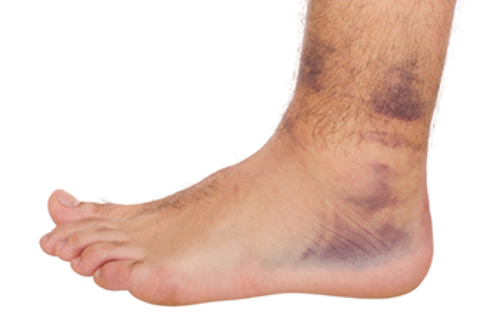 Smart Treatment For Ankle Sprains
