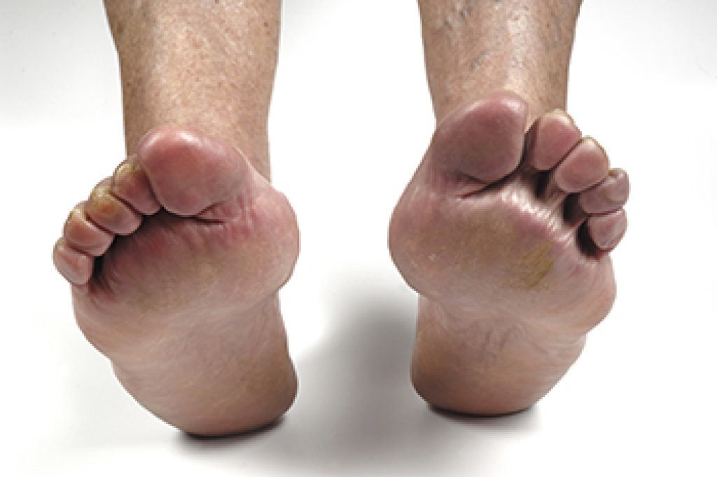 How Rheumatoid Arthritis Affects the Feet and Ankles